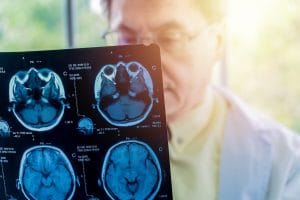 How Can AI be Beneficial for Dementia Care Doctor holding a brain scan